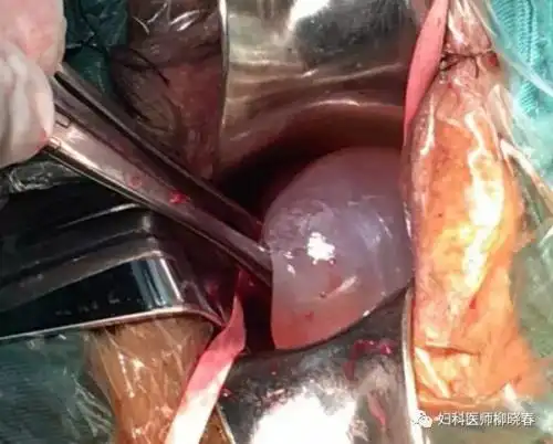 惊心!胎儿脚丫都出来了,我用手将胎儿塞回子宫