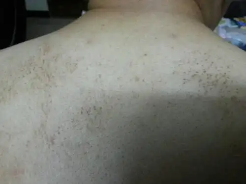 背上有一片黑点,不痛不痒,请问这是什么?