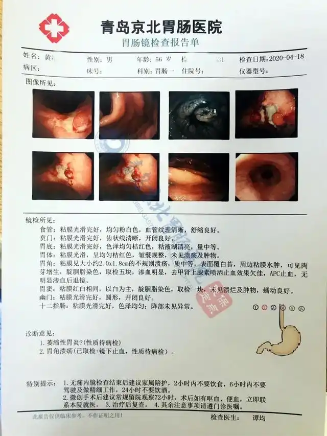 胃疼到胃癌需要多长的时间呢一个中老年患者的胃镜报告告诉你