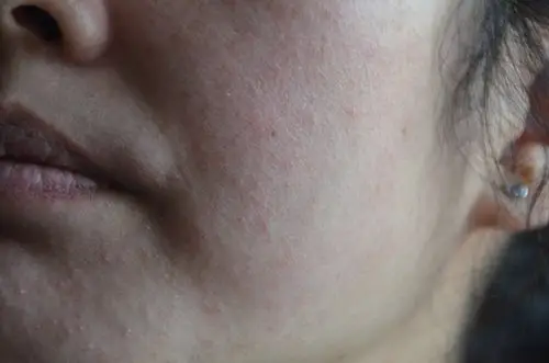 病情描述 面部发红起疹子有三年多了,看过医生说是脂溢性皮炎,近期