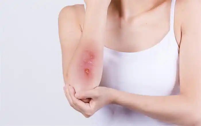 首次实现伤口无瘢痕愈合科学家开发出一种新型光诱导水凝胶修复胶囊