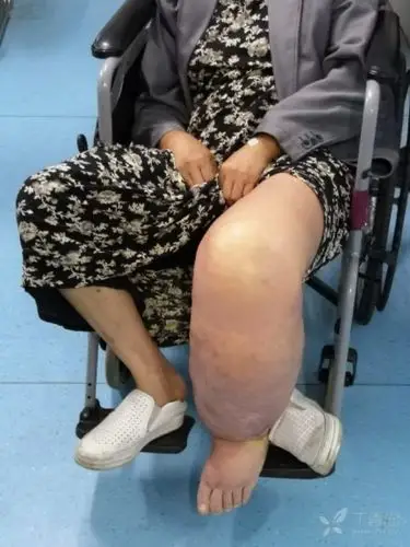 大象腿的治疗方法