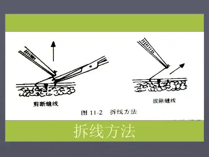 换药 包扎 拆线ppt