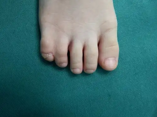连体小脚丫分家5个脚趾头灵活了