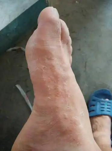 脚丫子上小疙瘩是 怎么回事 很痒 怎么解决