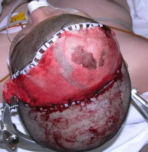 脑外伤术中脑膨出二期处理经典图片