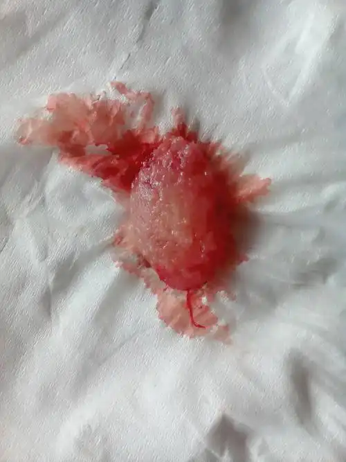 药流出来的孕囊图片