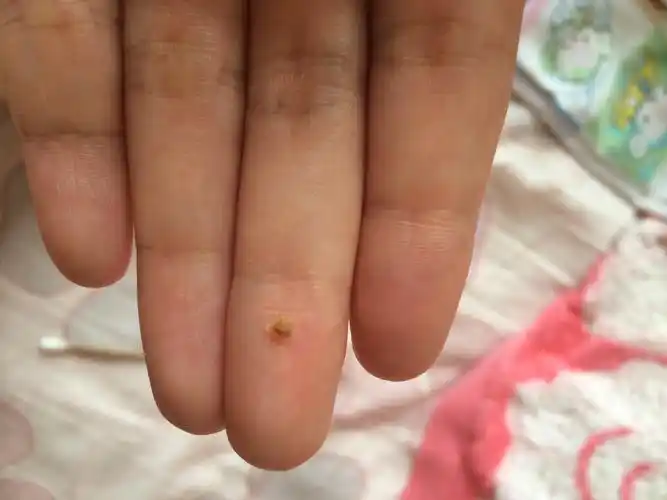 问:宝宝耳屎这样正常吗