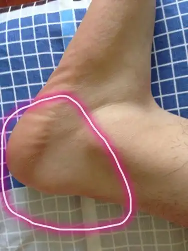 您好,我今天早上起来左脚脚后跟外侧突然肿起一个包,摸上去硬硬的