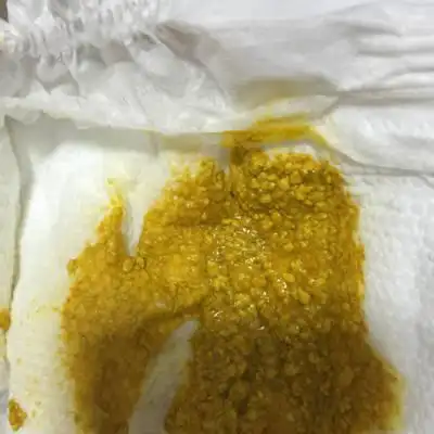 我家孩子20天,大便有奶瓣,有时侯还漾奶,偶尔从鼻子里出奶,请问是怎麼