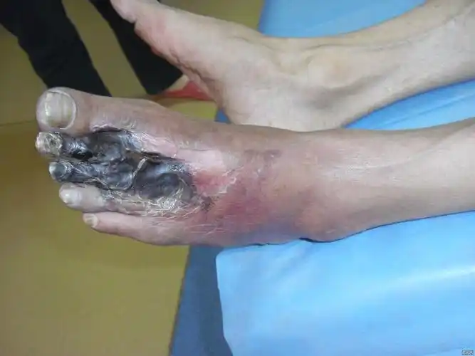 左下肢动脉闭塞症