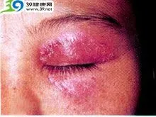 眼睑湿疹
