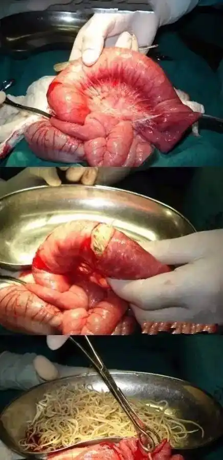 宝宝肚裏竟"养"了蛔虫?