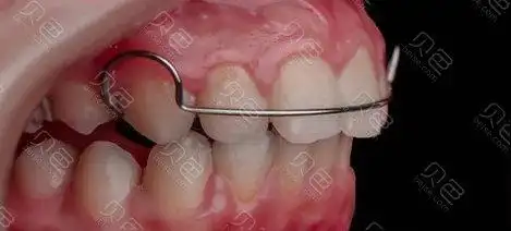 平导矫正器是什么?在正畸中起到什么作用?带你深入了解!