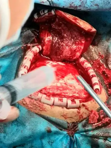 大量脑出血开颅血肿清除去骨瓣减压