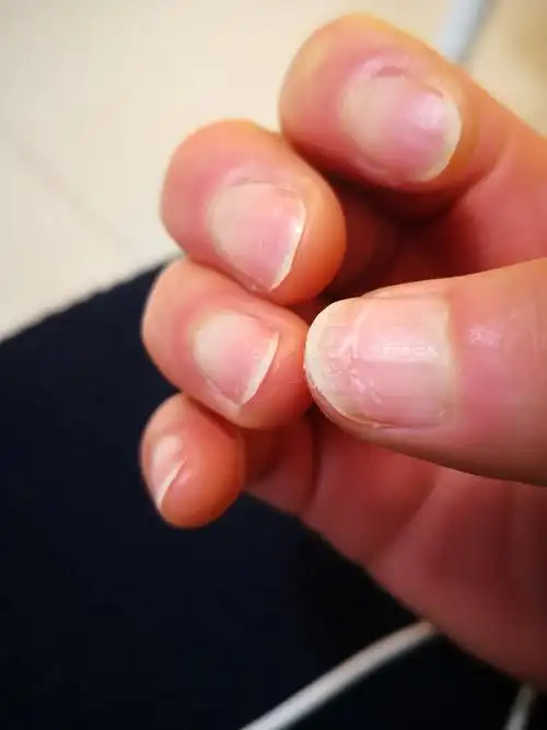 指甲薄软断裂什么原因?是缺维生素吗还是有什么病