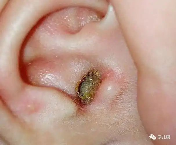 专家在线丨小心这种耳朵可能会偷走宝宝的听力