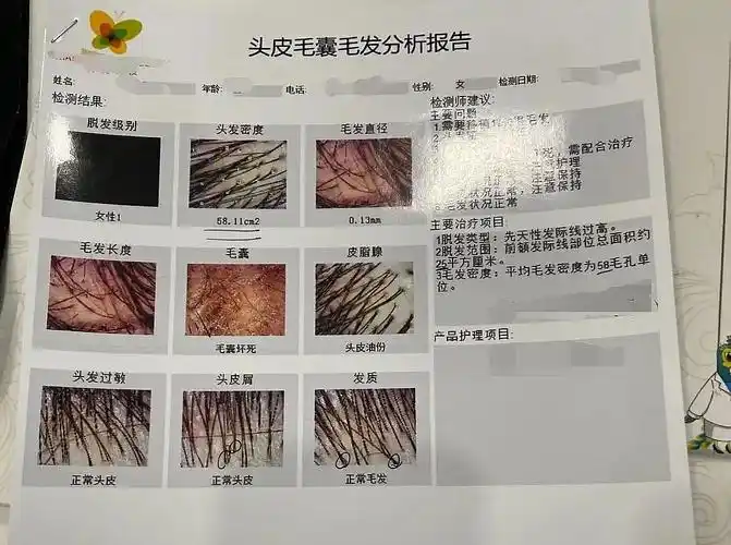 然后用毛囊检测仪给我测了一下头皮和毛囊的情况,还出了一份分析报告