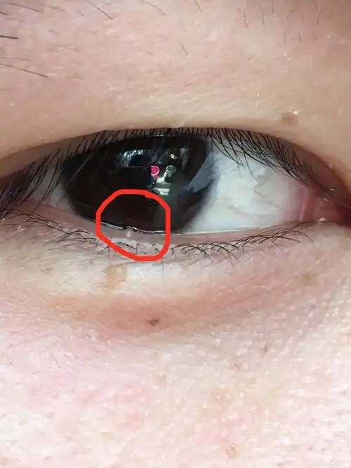 眼皮下面长了个淡黄色的小疙瘩