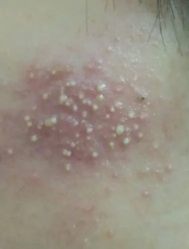 擦祛痘膏后过敏长密集小痘痘,怎么办?