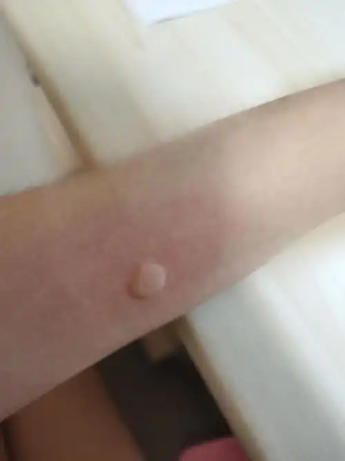 怎么会被蚊子咬这么大一个包啊