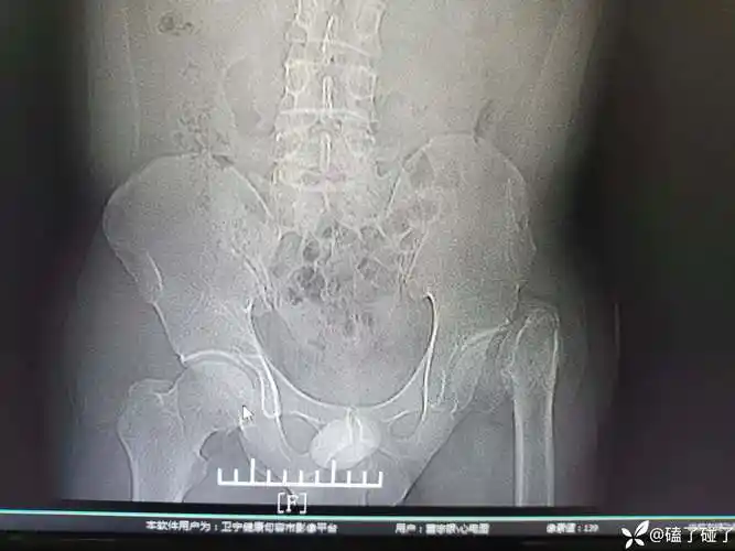 病历分享|30岁男性陈旧性髋关节骨折,望各位老师提供建议