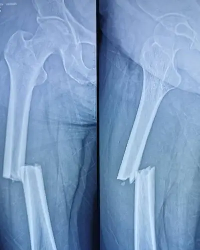 股骨干合并股骨颈骨折一例