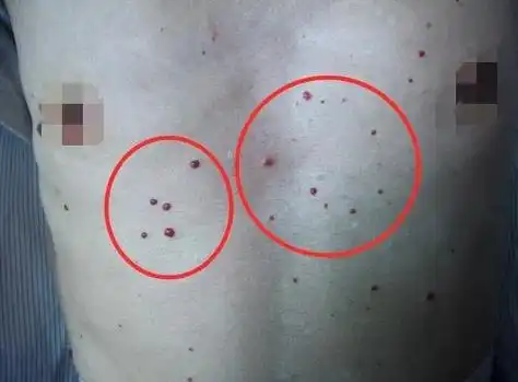 身上莫名其妙出现血痣,红痣,到底是什么?