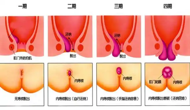 内痔疮有什么表现和症状