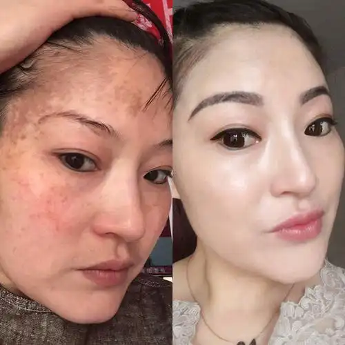 抖音同款【女人变美因为它】 斑点克星 恢复嫩白肌肤