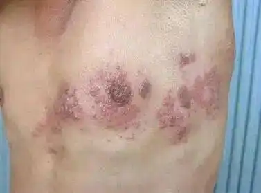 单纯疱疹和带状疱疹辨别和用药