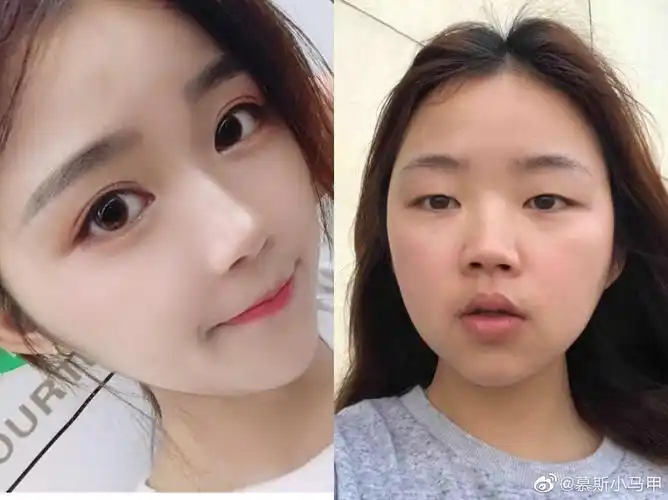 小眼睛如何变变大眼睛全切双眼皮3个月过程分享