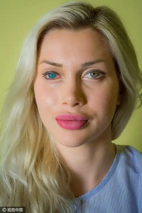 美国女模整容19次拆6根肋骨 改变眼球颜色