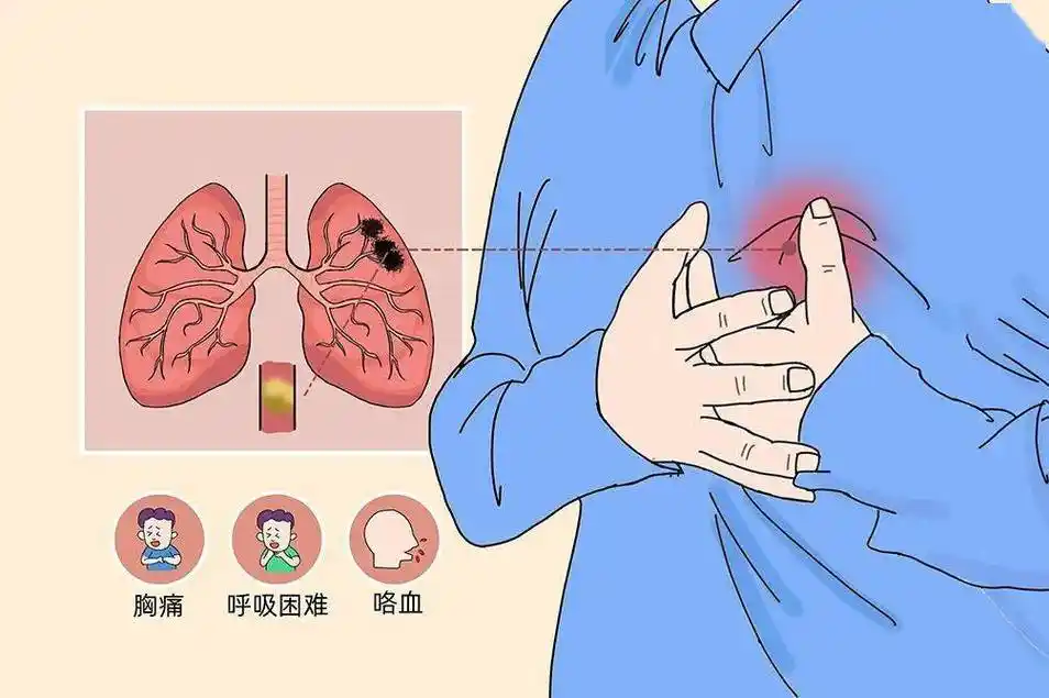 【金秋之声】肺栓塞——老年人身边的"沉默杀手"
