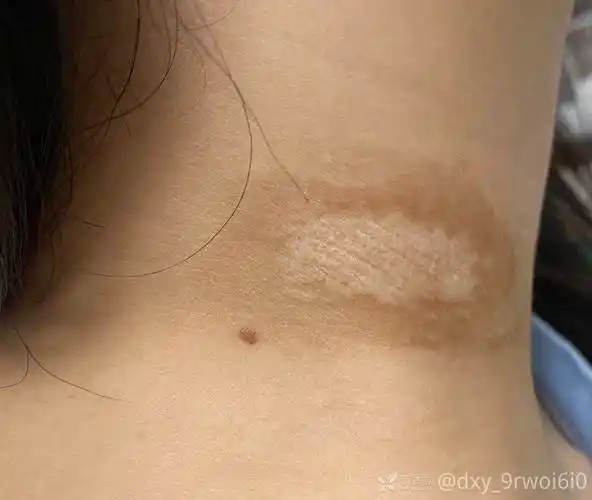 求助颈部白斑这是什么病