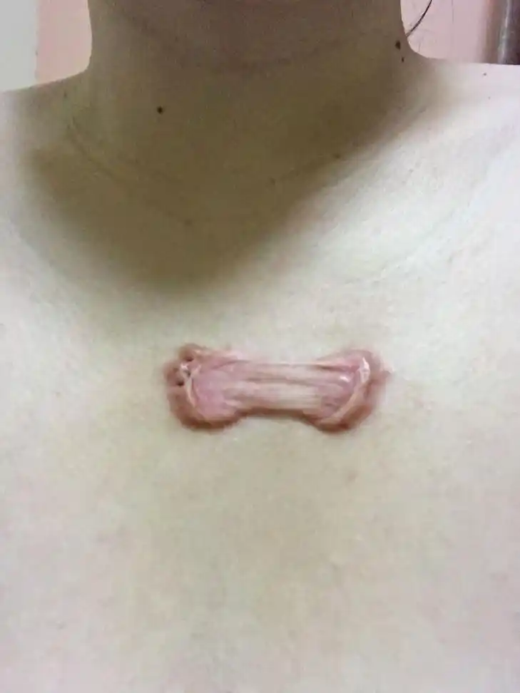 胸口有疤痕疙瘩,8年前夏天蚊虫叮咬挠破后留的伤口,当时很小,这么多年