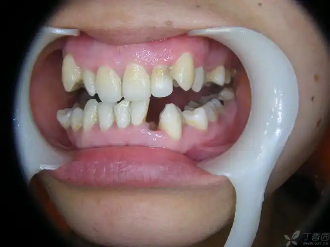 【经验交流】下侧切牙双根一例