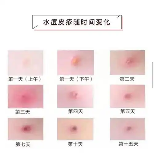 水痘是由水痘-带状疱疹病毒感染引起的一种急性传染病,一般