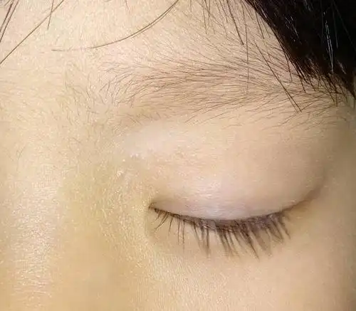 宝宝眼眶周围皮肤发白是皮肤病么?