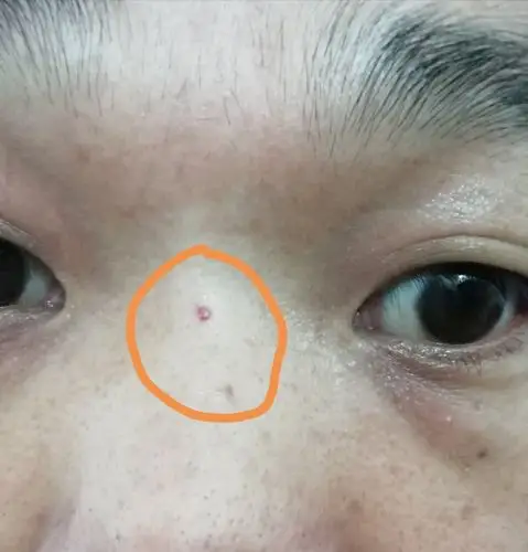 鼻梁中红斑一年不退