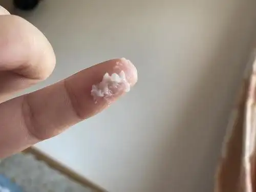 用了几天晶丽康白带突然多起来粘稠是不是霉菌复发了外阴痒