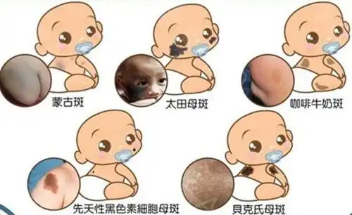 婴幼儿各种胎记和斑痣解析大全,建议家长收藏!