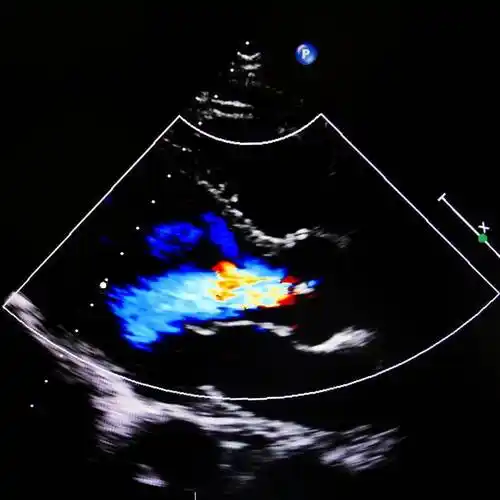 关爱生命 从心脏开始_检查_冠状动脉_心电图