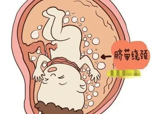 脐带绕颈二周能顺产吗 脐带绕颈一周还能顺产吗