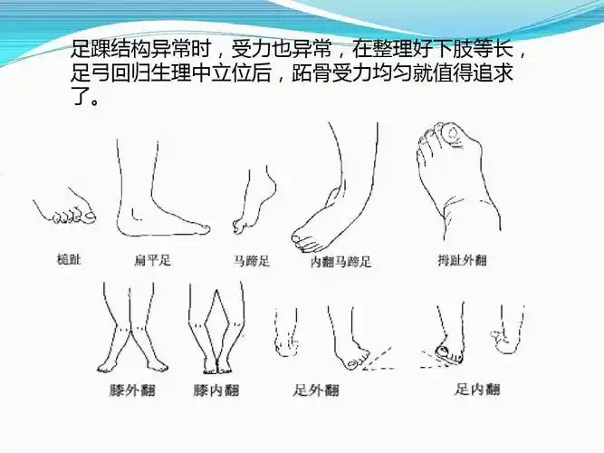 下肢生物力学矫形之--跖骨受力分配(三)ppt