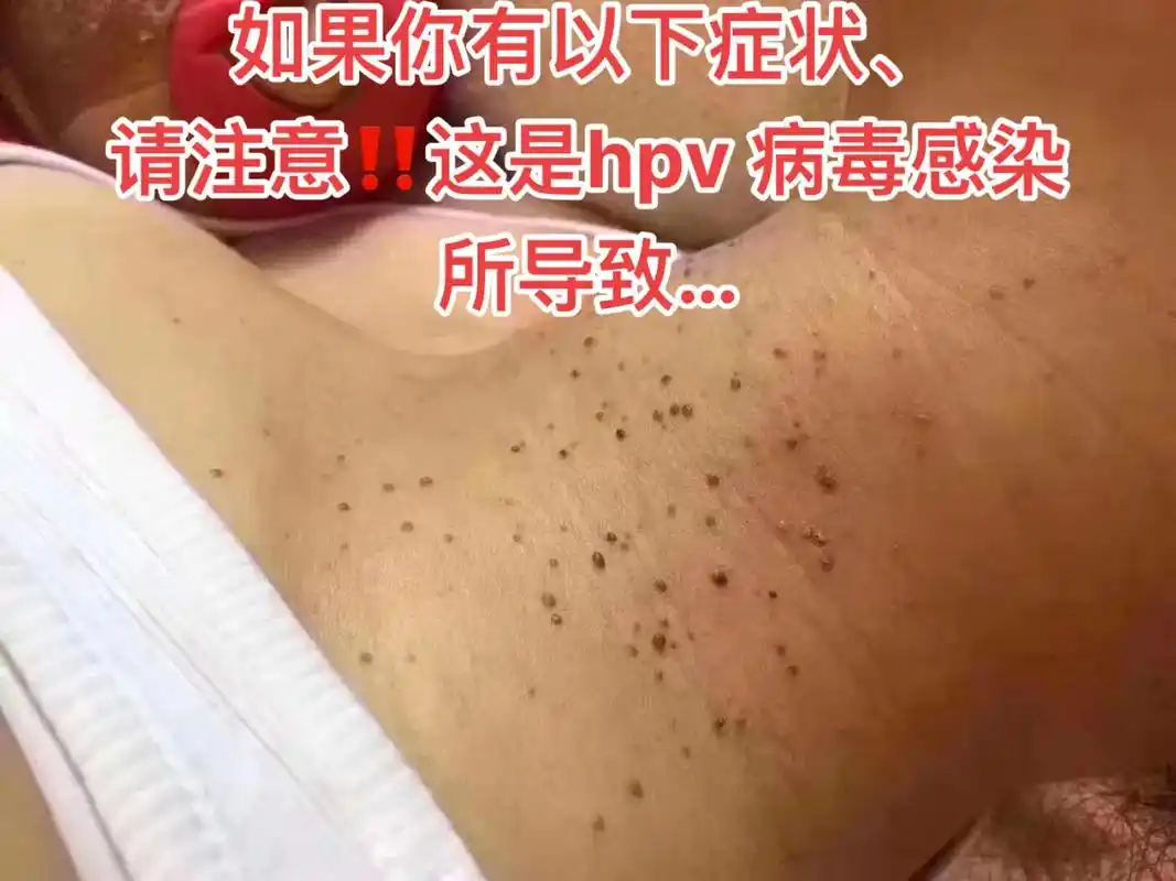 此症状为hpv 病毒感染:由于自身免疫力低下容易爆发赘生物, - 抖音
