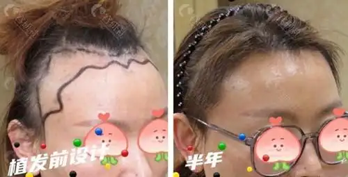西安国医中心整形医院陈娟发际线种植术前术后对比