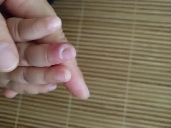 两个月宝宝手指第一节发黄 婴儿手指第一节发黄-图片大观-奇异网