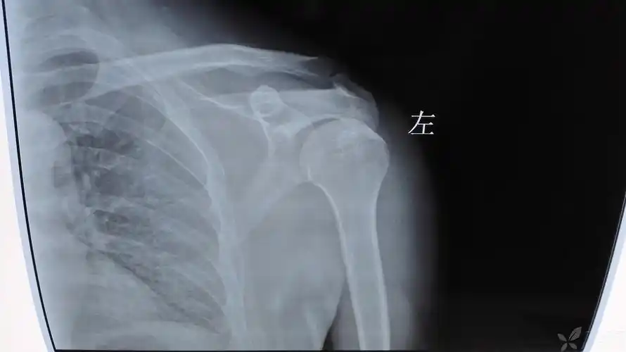 这是难见的肩关节损伤吧?