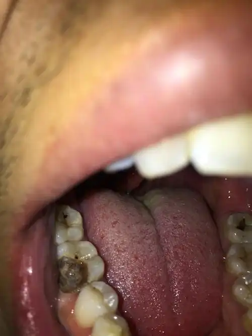 请问这样的蛀牙该怎么治?